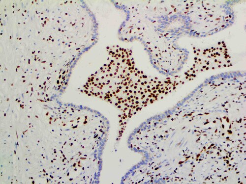 IHC of ERG on an FFPE Prostate Carcinoma Tissue
